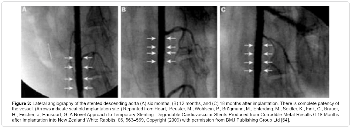 biotechnology-biomaterials-Temporary-Stenting