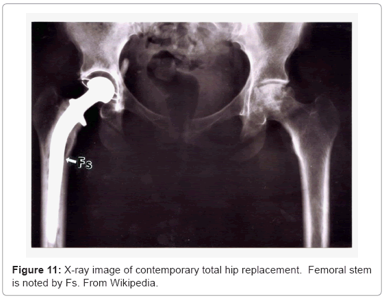 biotechnology-biomaterials-hip-replacement