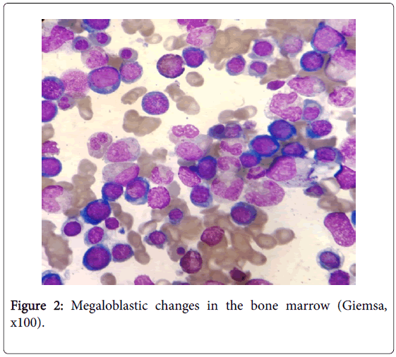 A Case With Pancytopenia And Autoimmune Hemolytic Anemia Due To - 561x506 - png B12 Deficiency Bone Scan