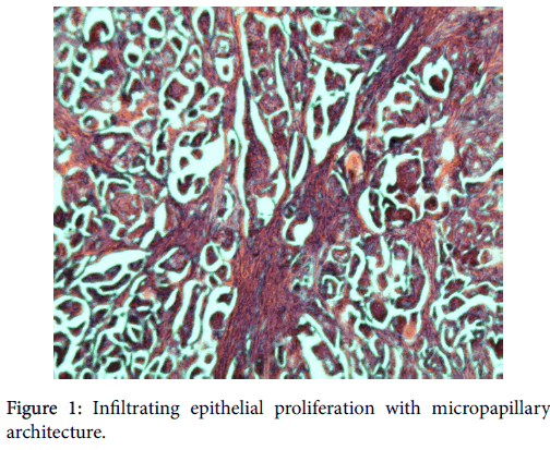 breast-cancer-Infiltrating-epithelial-proliferation