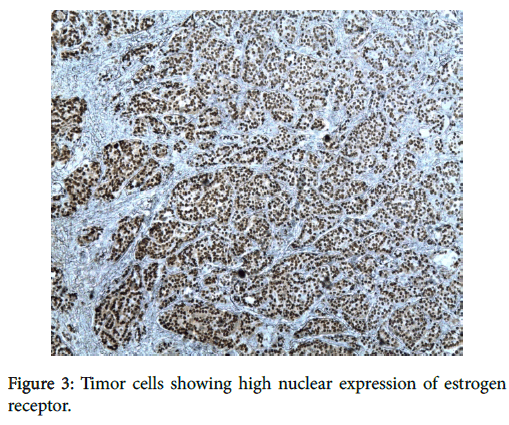 breast-cancer-nuclear-expression-estrogen