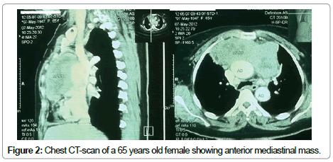 mediastinal lymphosarcoma