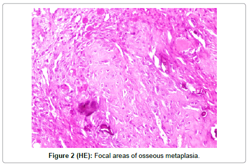 breast carcinoma and osseous metaplasia Women wrestling sexy