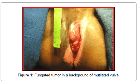 Adenocarcinoma of the vulva photos 246