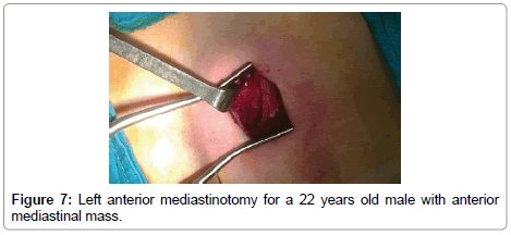 mediastinal lymphosarcoma