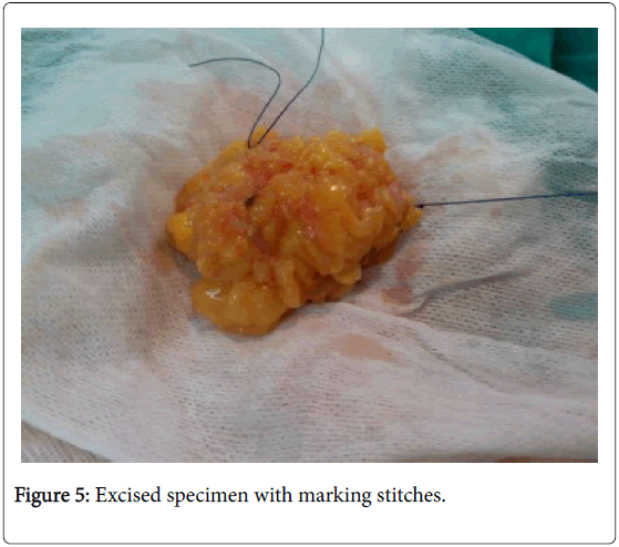 cancer-surgery-Excised-specimen