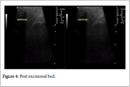 cancer-surgery-Post-excisional