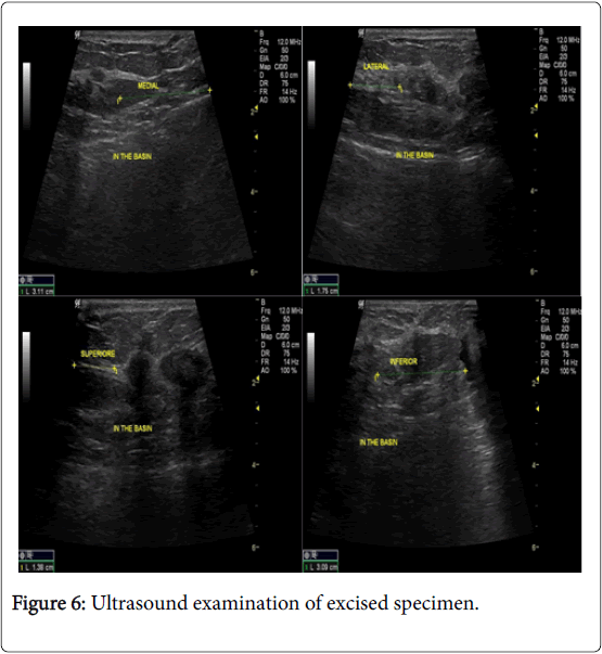 cancer-surgery-Ultrasound-examination