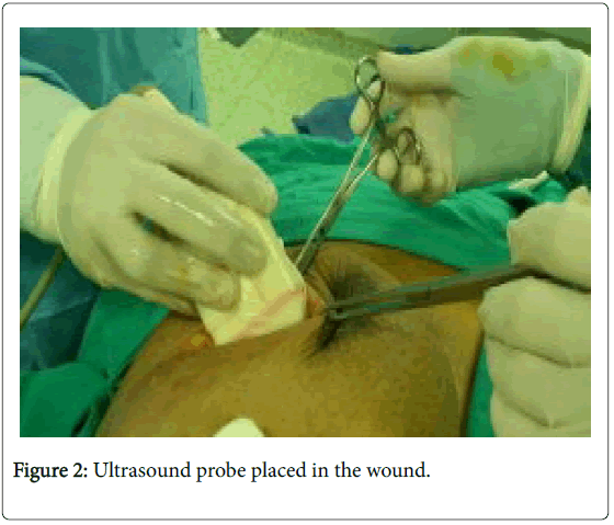 cancer-surgery-Ultrasound-probe