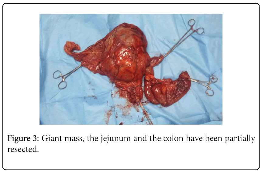 cancer-surgery-jejunum