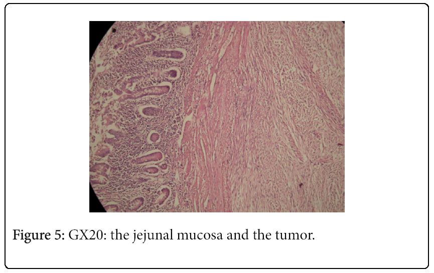 cancer-surgery-mucosa