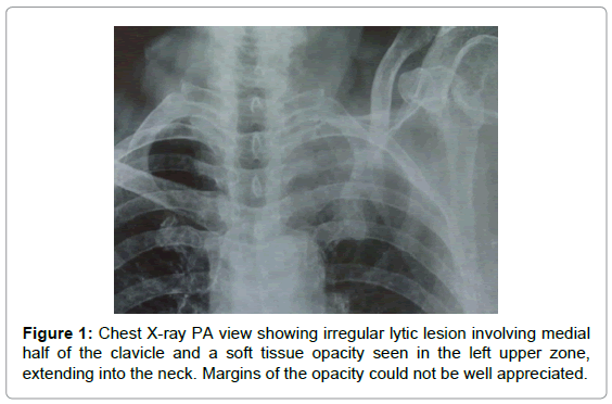 cervical-cancer-Chest-X-ray