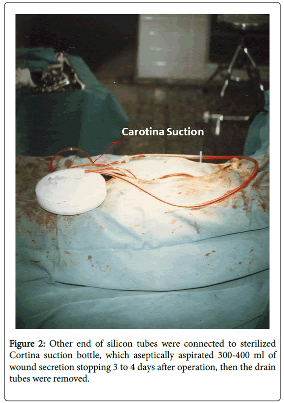 cervical-cancer-Cortina-suction-bottle