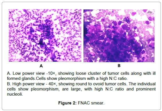 cervical-cancer-Low-power