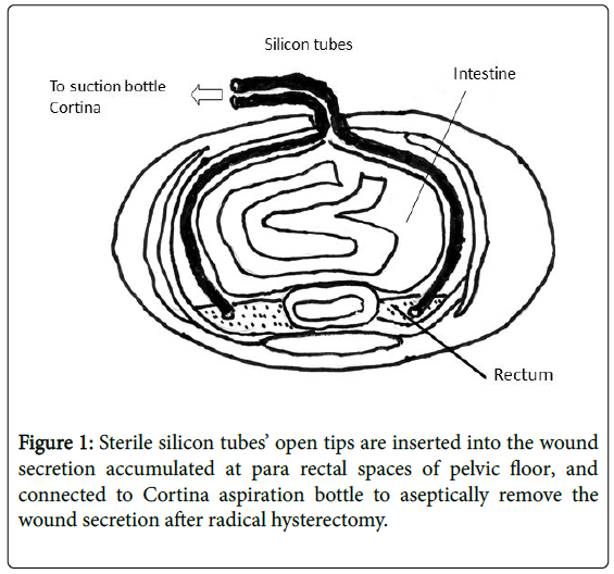 cervical-cancer-Sterile-silicon