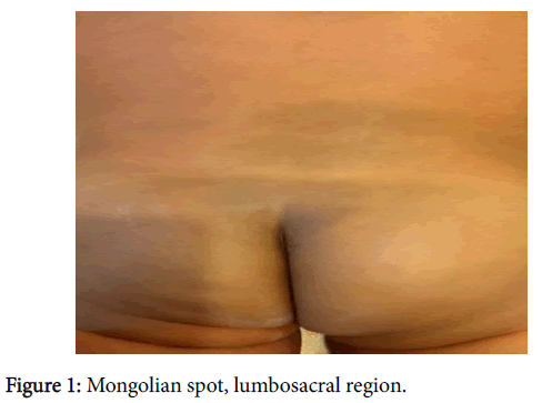 child-health-Mongolian-spot