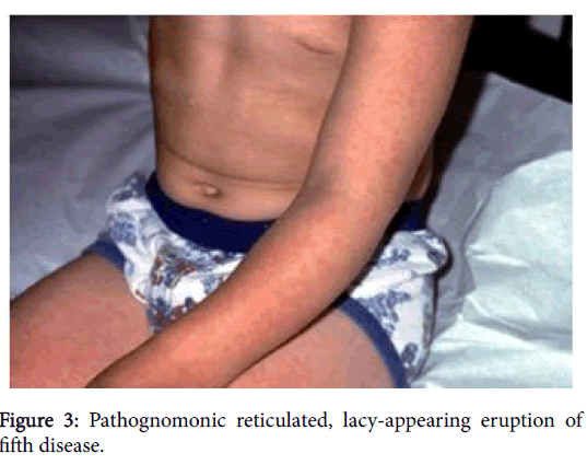 child-health-Pathognomonic-reticulated