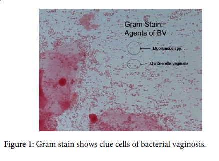 child-health-bacterial-vaginosis
