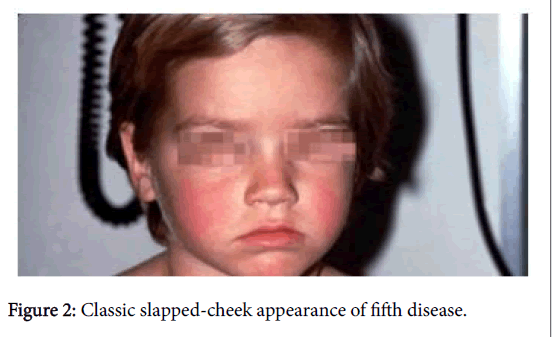 child-health-fifth-disease