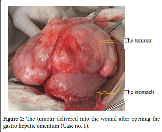 child-health-hepatic-omentum