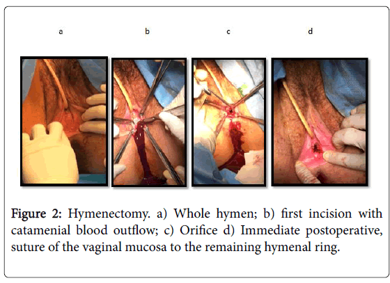 child-health-hymenal-ring