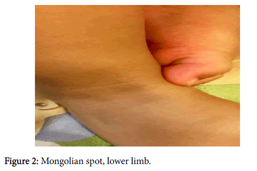 child-health-lower-limb