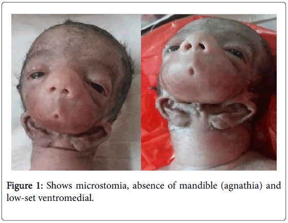child-health-mandible-agnathia