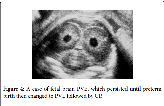 child-health-persisted-preterm