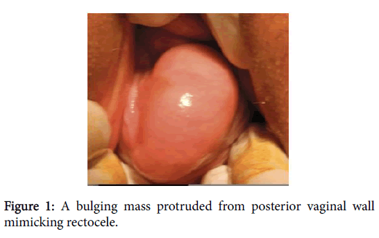 A large posterior vaginal wall cyst simulating rectocele: an account of an  unusual perplexing case - Document - Gale Academic OneFile