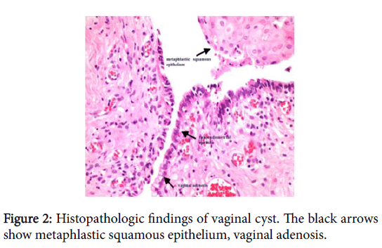 child-health-vaginal-adenosis