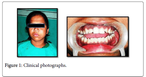 non syndromic multiple odontogenic keratocysts a case report and odontogenic keratocyst