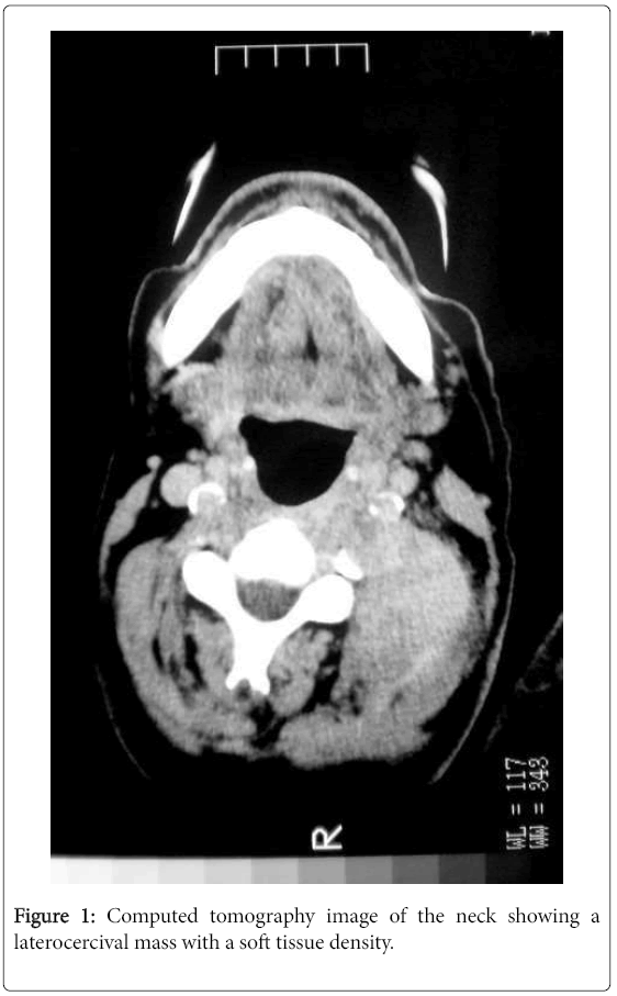 lymphoma case study Dr stefano luminari reviews the case of a 23-year-old female with classical hodgkin lymphoma and nodular sclerosis. lymphoma case study Dr stefano luminari reviews the case of a 23-year-old female with classical hodgkin lymphoma and nodular sclerosis.