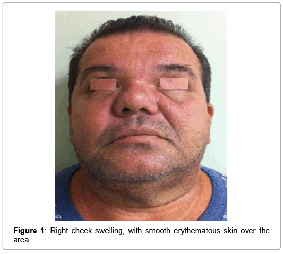 Clinical Case Reports Cheek Swelling