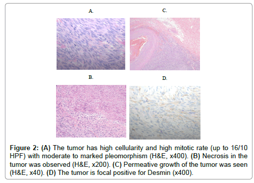 myxoid endometrial stromal sarcoma a case report and literature