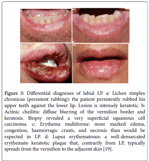 Lichen Simplex Chronicus Natural Treatment Lichen Simplex Chronicus Natural Treatment