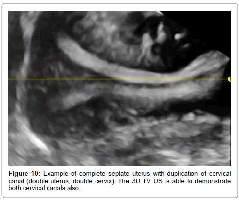 3D Ultrasound Assessment of the Uterus: Why an Accuracy ...