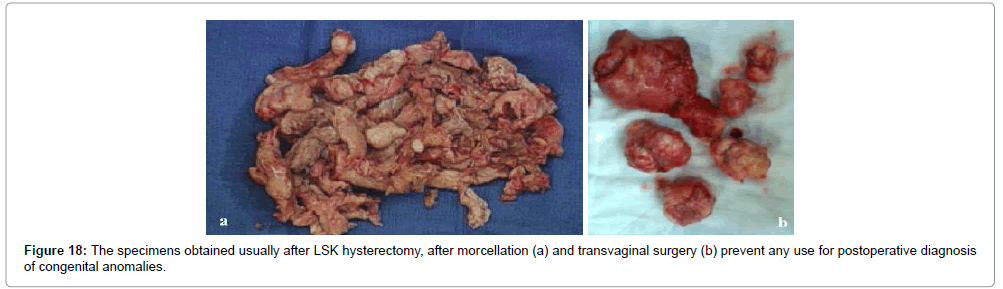 clinical-diagnosis-duct-hysterectomy