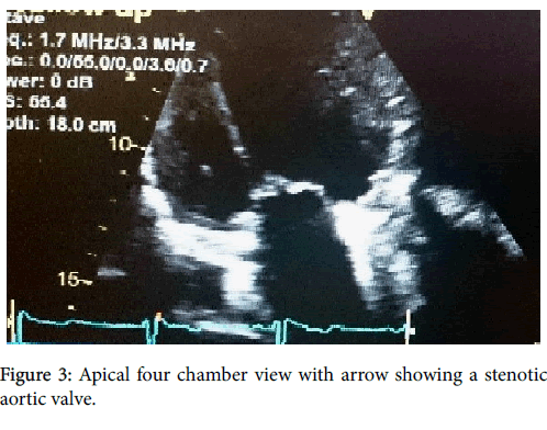 clinical-diagnosis-research-Apical-four-chamber-view