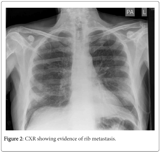 clinical-diagnosis-research-CXR-showing-evidence
