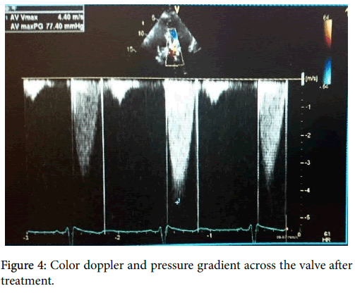 clinical-diagnosis-research-Color-doppler-pressure-gradient