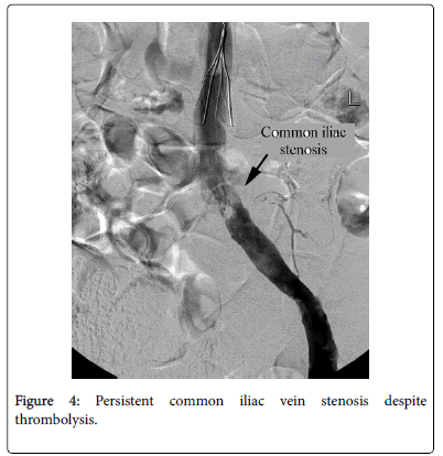 clinical-diagnosis-research-Persistent-common-iliac