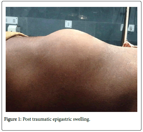 clinical-diagnosis-research-Post-traumatic-epigastric-swelling