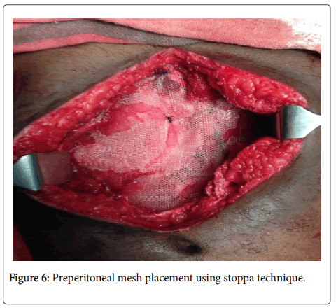clinical-diagnosis-research-Preperitoneal-mesh-placement