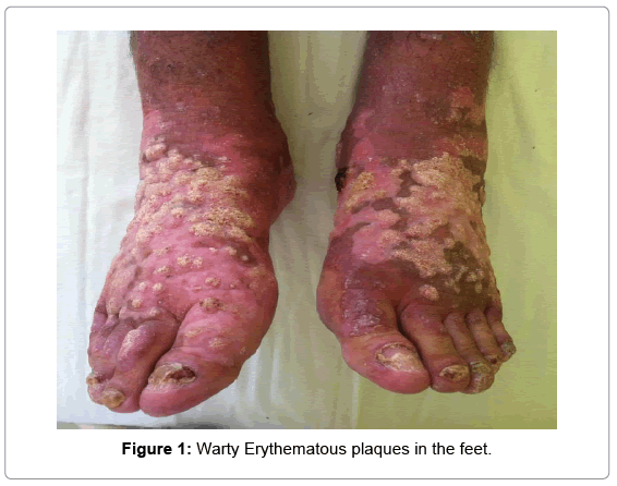 clinical-diagnosis-research-Warty-Erythematous-plaques