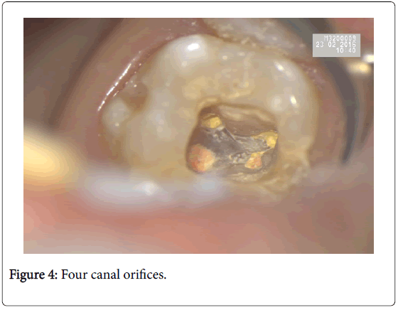 clinical-diagnosis-research-canal-orifices