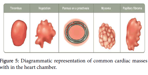 clinical-diagnosis-research-common-cardiac-masses