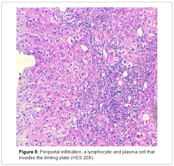 clinical-diagnosis-research-lymphocytic-plasma-cell