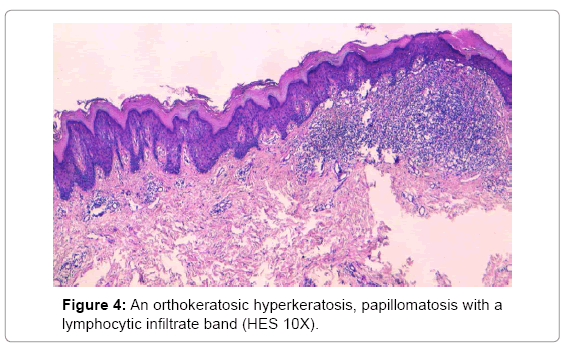 clinical-diagnosis-research-orthokeratosic-hyperkeratosis