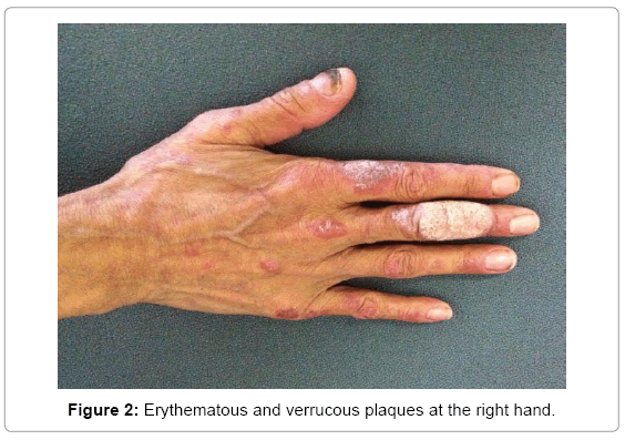 clinical-diagnosis-research-verrucous-plaques-right-hand