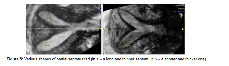 clinical-diagnosis-thinner-septum